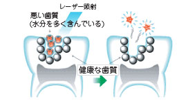 レーザー治療って何？