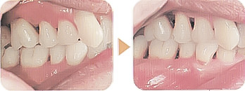 歯周病治療/歯周病の予防