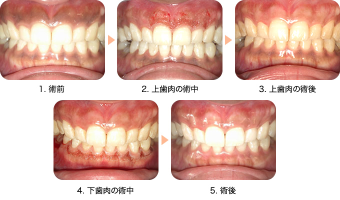 歯ぐきの黒ずみを消す(色素沈着除去)