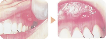 口内炎・口角炎/義歯による傷口の殺菌