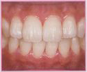 whitening_5